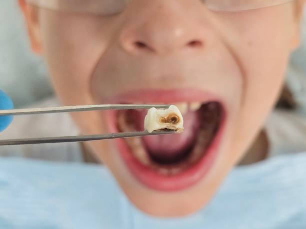 Best Emergency Treatment for Oral Infections in Paradise, CA